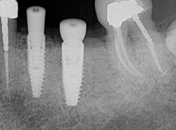 X-ray of an implant in position